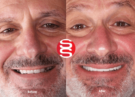 Dental Implants